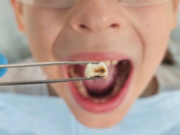 Best Emergency Root Canal Treatment in Ingleside, TX